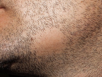 BEARD HAIR LOSS