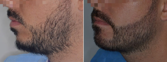 Beard SHAPING