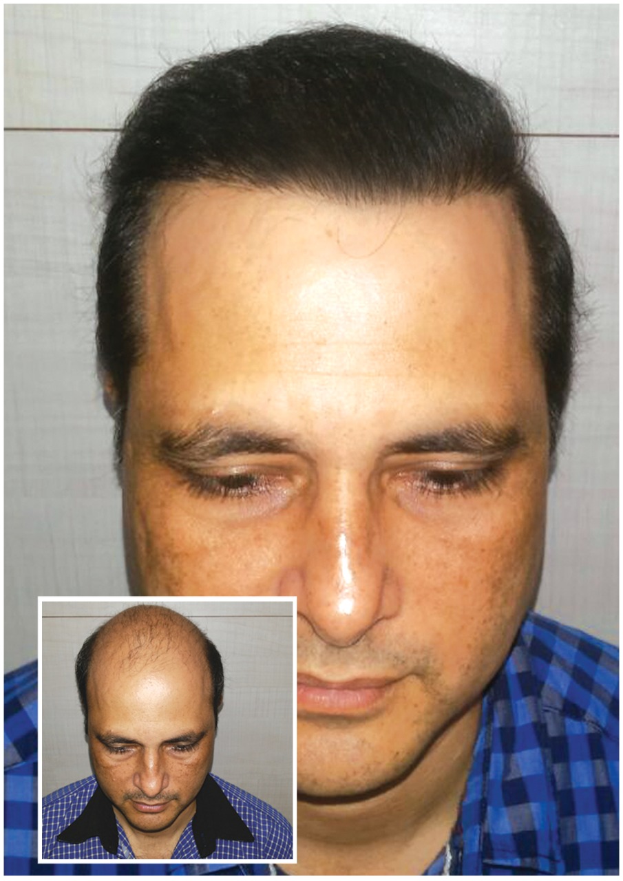 Kayna Cosmetic Clinic Hair Transplant Photo 1