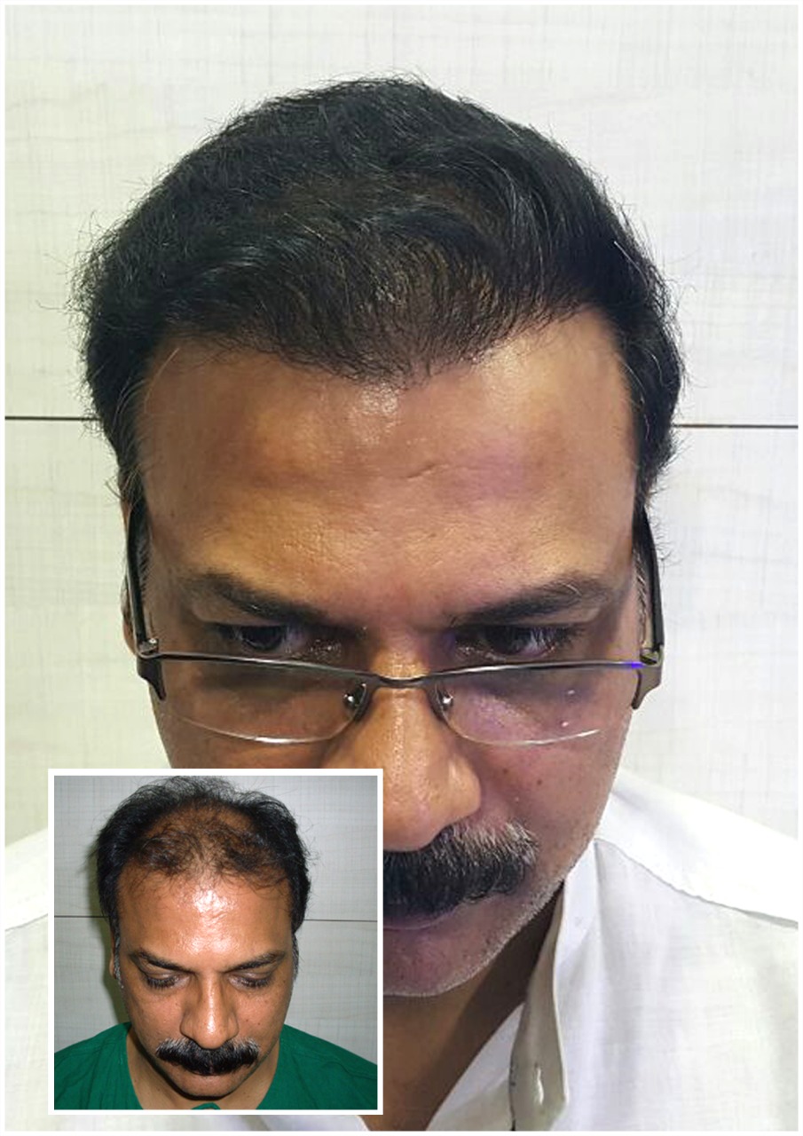 Kayna Cosmetic Clinic Hair Transplant Photo 2