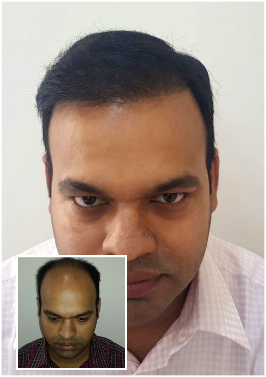 Kayna Cosmetic Clinic Hair Transplant Photo 3