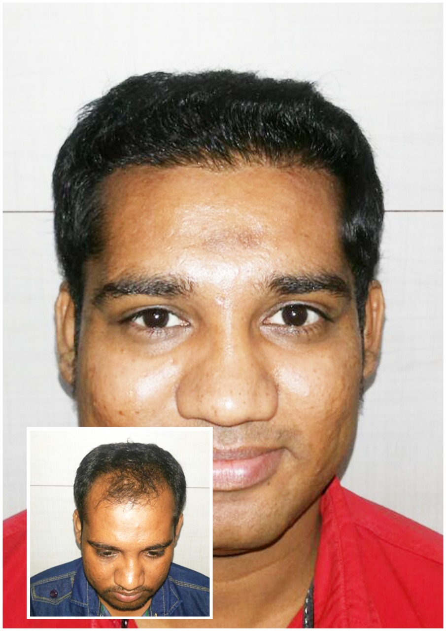 Kayna Cosmetic Clinic Hair Transplant Photo 4