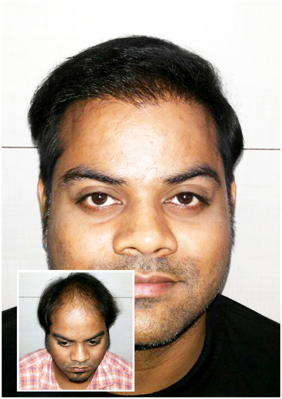 Kayna Cosmetic Clinic Hair Transplant Photo 5