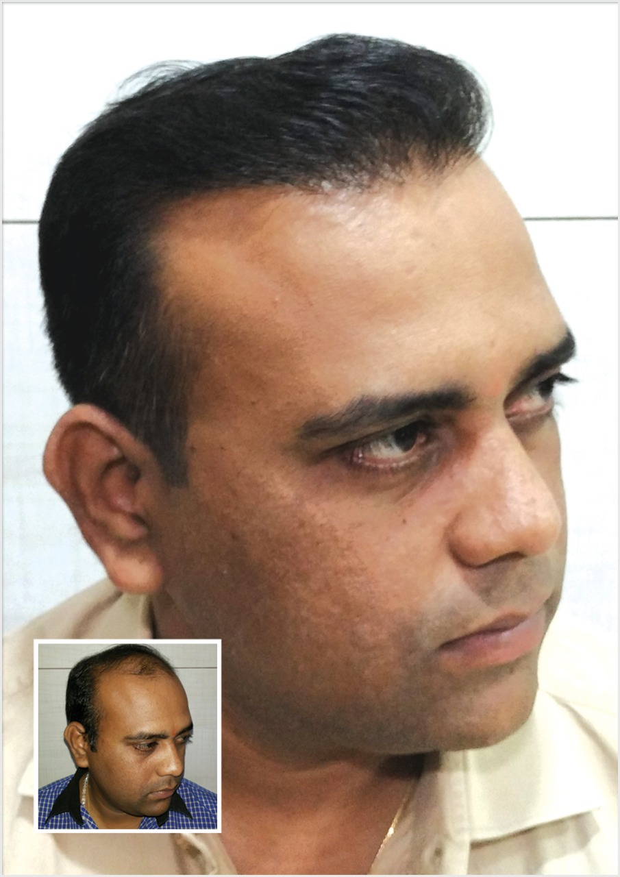 Kayna Cosmetic Clinic Hair Transplant Photo